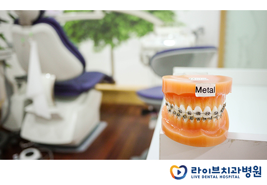 교정기의 다양한 종류를 알아보자! 관련 이미지 3