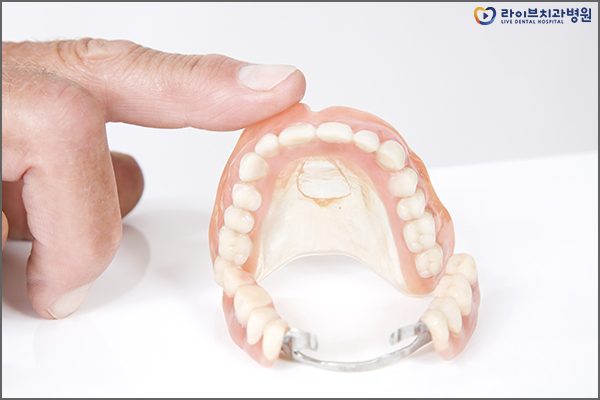 임플란트틀니 어떠한 다른점이 있을까요? 관련 이미지 5