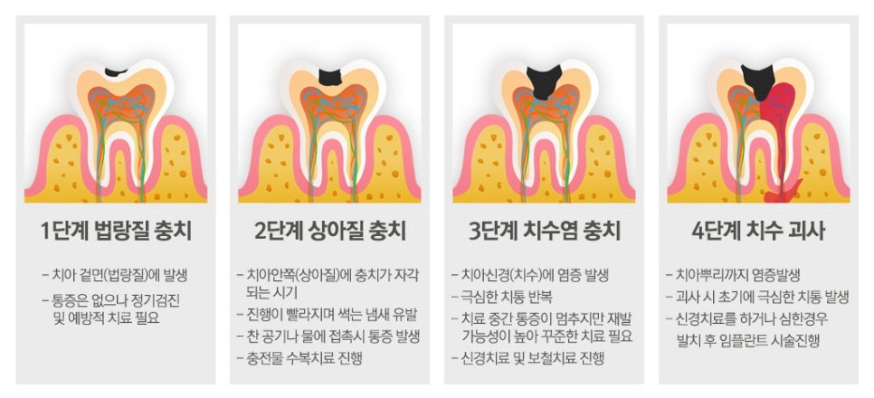 충치치료, 빠를 수록 좋아요! 관련 이미지 3