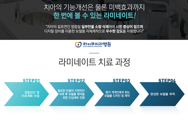 라미네이트 치료 과정이 뭘까요? 관련 이미지 4