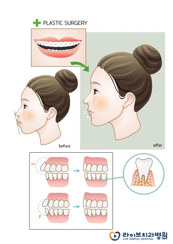 돌출입교정, 비수술로 찾는 자신감! 관련 이미지 3