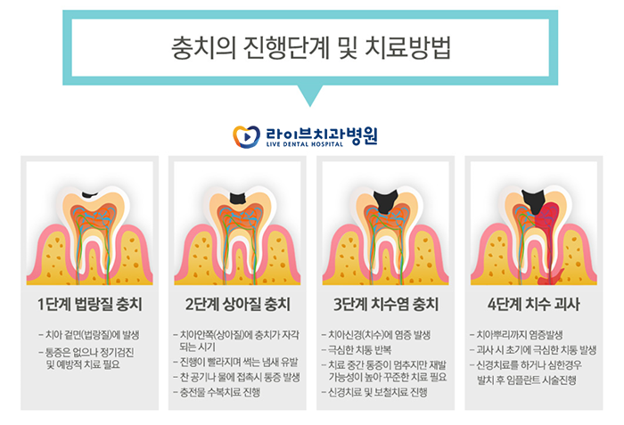 충치치료 후 통증 왜 아픈걸까요 관련 이미지 3
