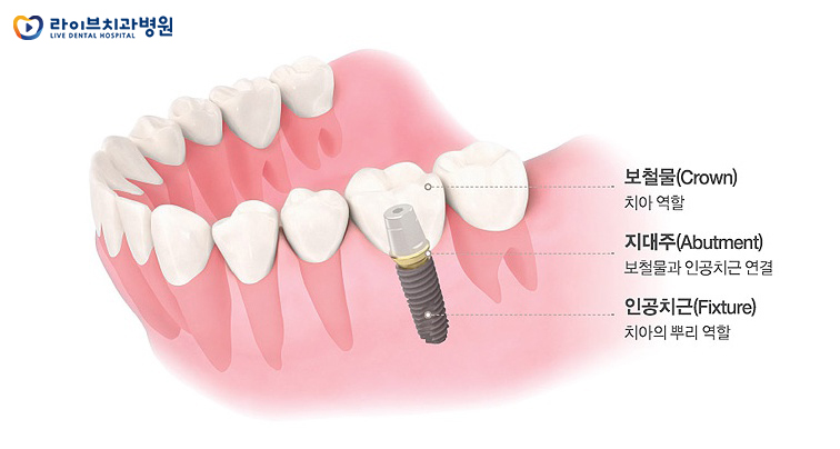 인천임플란트, 이제 멀리서 찾지 마세요! 관련 이미지 2