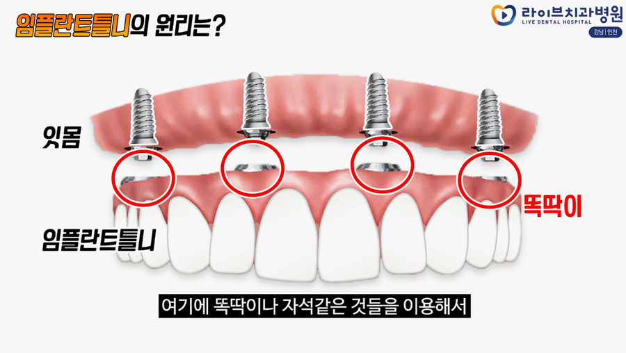 임플란트가 갑자기 빠진다면?! 임플란트 탈락, 임플란트 틀니 등 보철과전문의가 말해주는 임플란트! [응답하라치과의사 보철치료편] 관련 이미지 3
