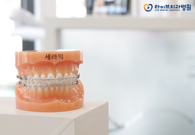 치아교정장치, 장점과 단점은 무엇일까요? 관련 이미지 4