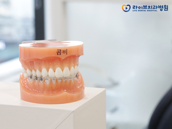 치아교정장치, 장점과 단점은 무엇일까요? 관련 이미지 8