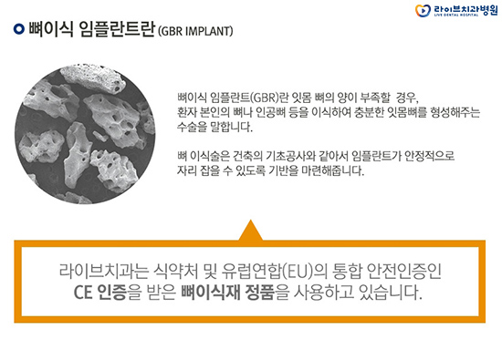 임플란트 뼈이식 꼭 해야되는 걸까요? 관련 이미지 3