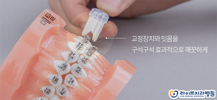 치아교정 양치질 어떻게 해야할까 관련 이미지 2