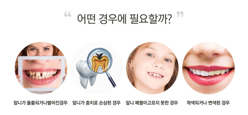 앞니라미네이트, 치아성형으로 자신감 회복! 관련 이미지 5