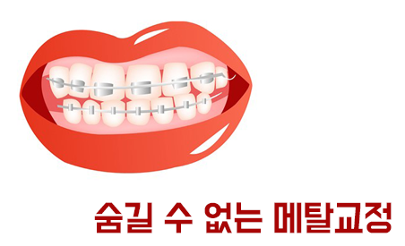 메탈교정, 튼튼하고 저렴하지만...?! 관련 이미지 3