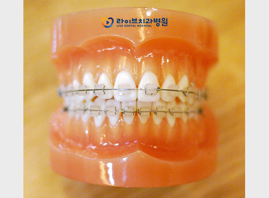 세라믹교정 잘하는 일요일치과 어디? 관련 이미지 2