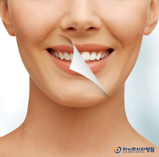 앞니교정, 필요한 부분만 쏘~옥! 관련 이미지 2