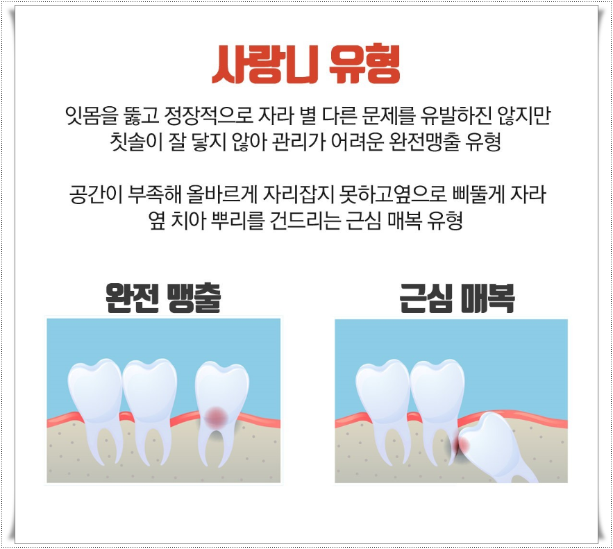 누운사랑니발치 매복된 사랑니 안뽑으면 안될까? 관련 이미지 3