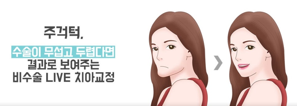 주걱턱교정, 교정만으로 치료가 가능한가요? 관련 이미지 2