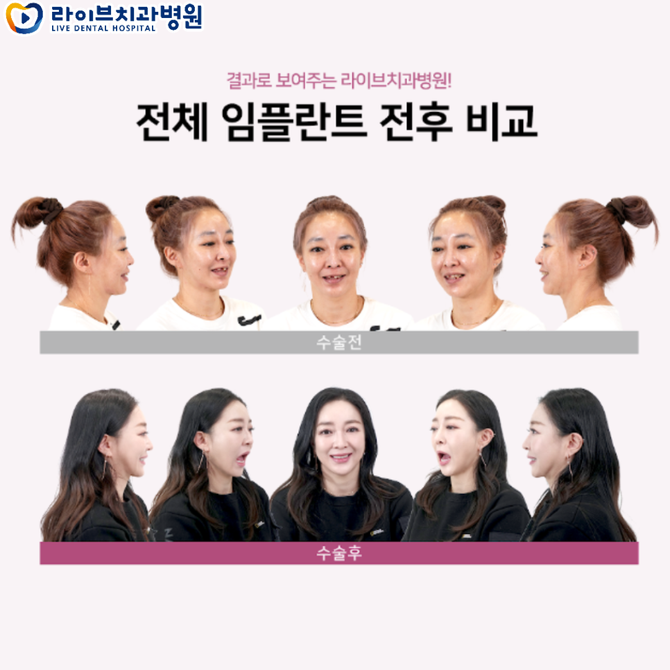 라이브치과병원 리얼스토리 전후 사진! 관련 이미지 2