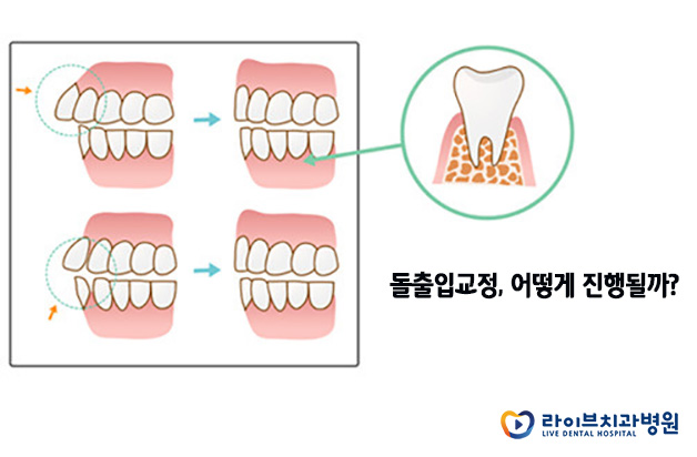 돌출입교정, 돌출입 콤플렉스를 벗어나는 방법 관련 이미지 3