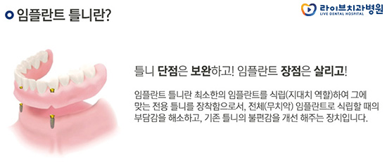 임플란트 틀니 어떨 때 하는걸까요? 관련 이미지 2