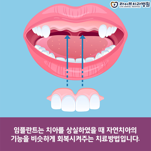 임플란트비용 보다 중요한 건? 관련 이미지 2