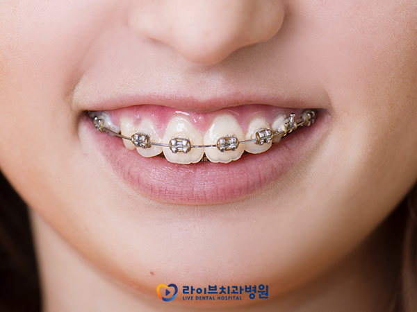 치아교정 통증, 그 정도는? 관련 이미지 2