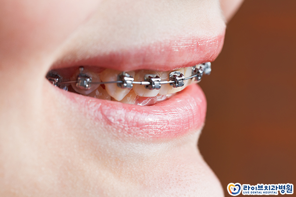 투명교정 가능할까요? 관련 이미지 2