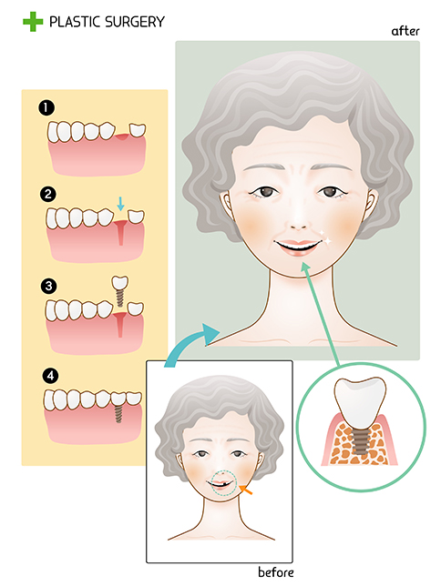 임플란트보험, 부담은 줄이고 만족은 높여요! 관련 이미지 2