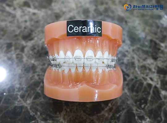 세라믹교정 잘하는 부평치과는 어디? 관련 이미지 2