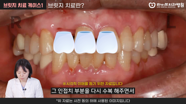 벌어진 앞니 보철 치료하는 방법 2탄[브릿지 치료, 임플란트, 치료진단, 치료계획]｜덴탈메이트 관련 이미지 3