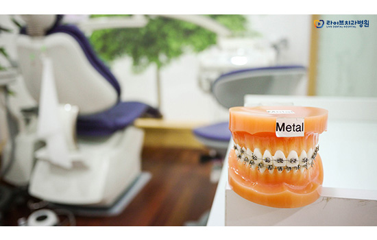 치아교정, 방법과 과정은? 관련 이미지 3