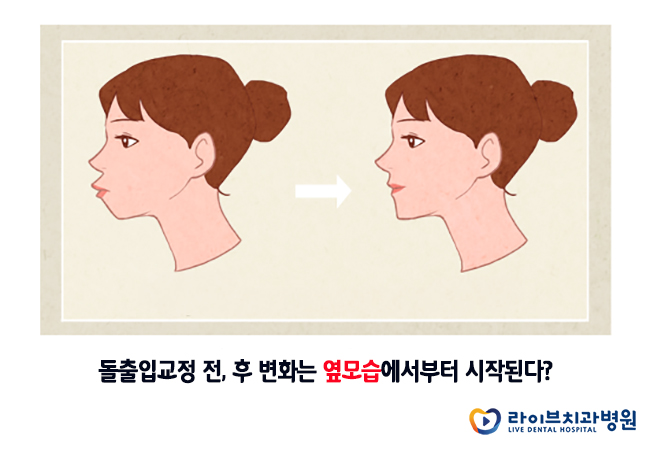 돌출입교정, 돌출입 콤플렉스를 벗어나는 방법 관련 이미지 4