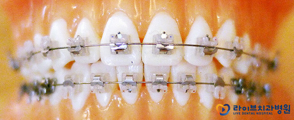 치아교정(: 브라켓 탈락 시 대처방법은? 관련 이미지 3