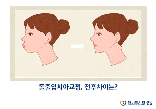 돌출입치아교정 잘하는 강남역치과 관련 이미지 2