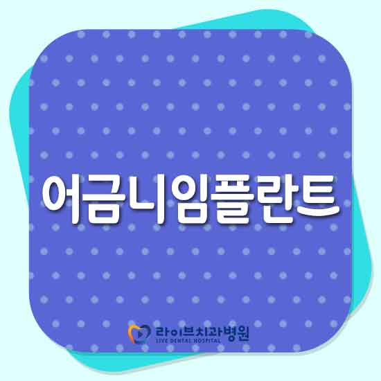 어금니임플란트 가격 찾아보고 있다면 관련 이미지 1