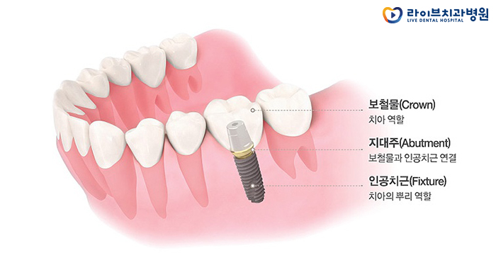 어금니임플란트, 올바른 치료로 오래 오래(: 관련 이미지 3