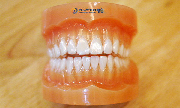 투명교정 가격 궁금하신가요? 관련 이미지 3