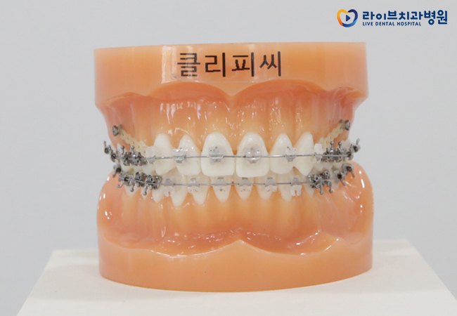 앞니부분교정, 내게도 적합한 치료일까? 관련 이미지 5