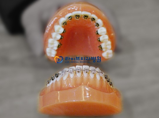 콤비교정, 위 아래 다른 스마트한 교정법! 관련 이미지 5