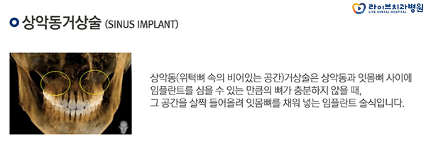 임플란트 뼈이식 꼭 해야되는 걸까요? 관련 이미지 5