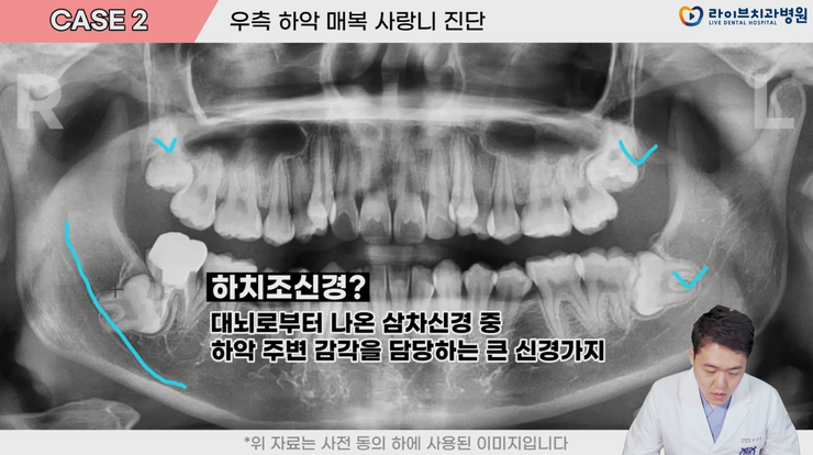 매복사랑니 꼭 뽑아야 하나요? | 덴탈메이트 관련 이미지 3