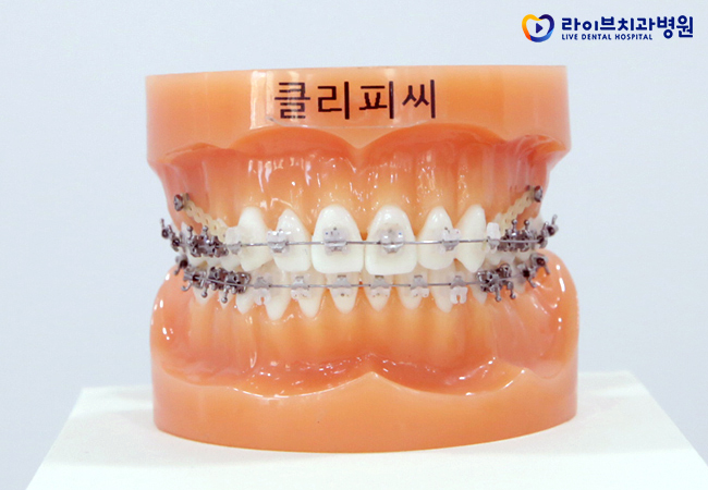 치아교정비용, 정확한 플랜으로 올바른 치료를! 관련 이미지 4