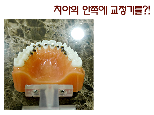 설측교정으로 교정을 숨겨보자! 관련 이미지 4