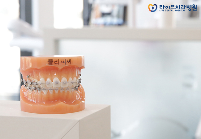 치아교정장치, 장점과 단점은 무엇일까요? 관련 이미지 3