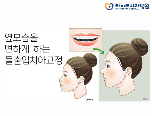 돌출입교정, 증상에 맞는 치료가 필요해요 관련 이미지 2