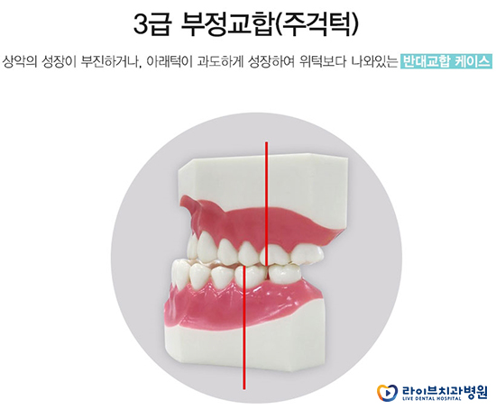 주걱턱교정 개선이 가능할까요? 관련 이미지 2