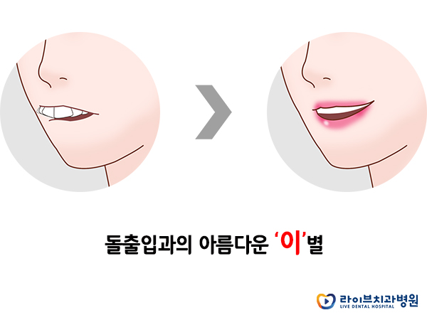 돌출입교정, 증상에 맞는 치료가 필요해요 관련 이미지 3