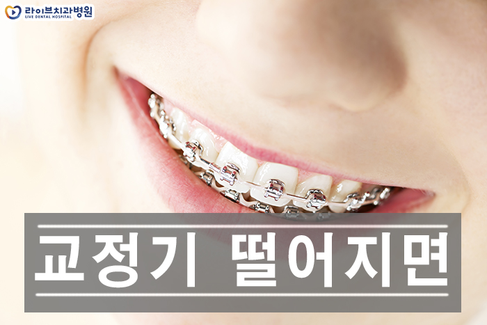 교정기 떨어지면 어떻게 하나요? 관련 이미지 1
