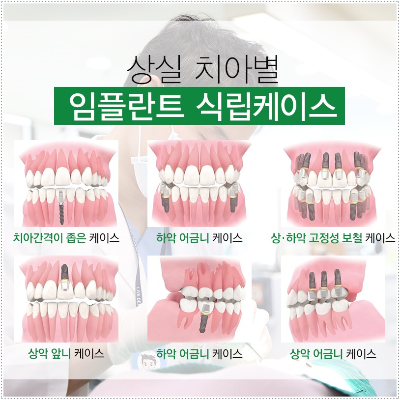 신논현역치과, 발치 즉시 임플란트 하려면? 관련 이미지 4