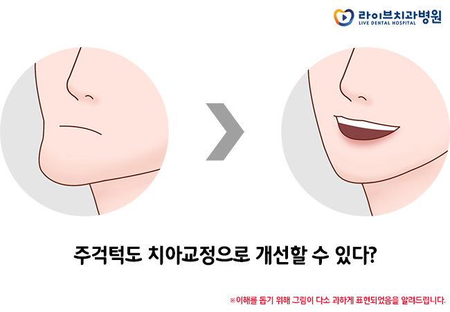 주걱턱교정, 올바른 치료와 유지를 위하여 관련 이미지 3