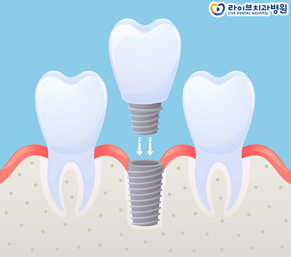 오스템임플란트 받아도 될까요? 관련 이미지 2