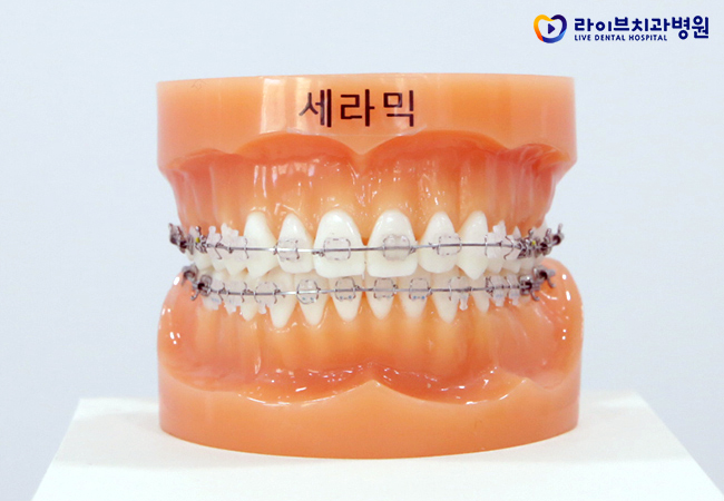 치아교정비용, 정확한 플랜으로 올바른 치료를! 관련 이미지 5
