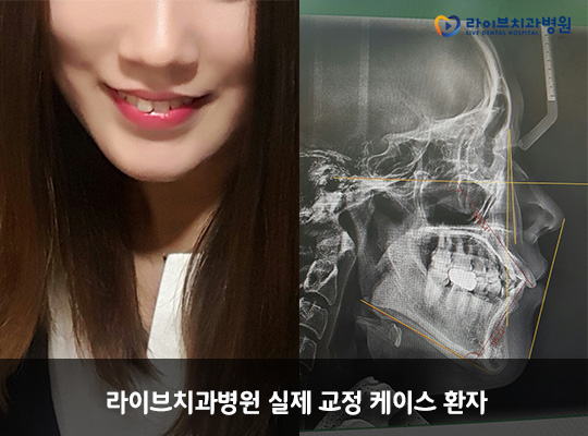 치아교정으로 찾는 자연스러운 입매 관련 이미지 2